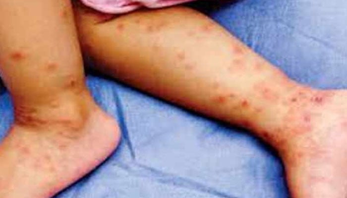 Sajawal, 4 children died of measles in Talib Rachho village