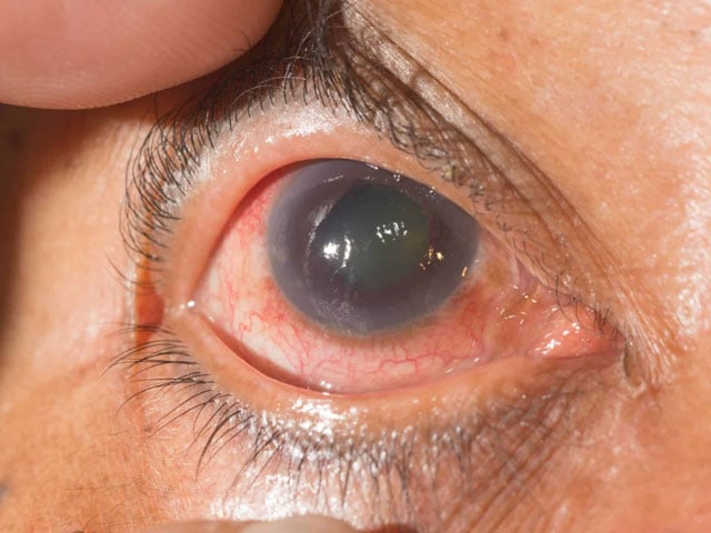 How to reduce the risk of black cataracts in the eyes?