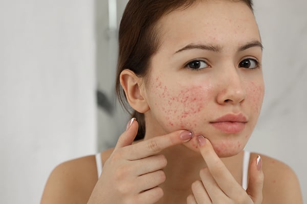 Products used for acne can cause cancer