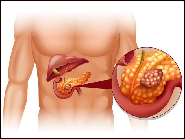 What are the common symptoms of pancreatic cancer?