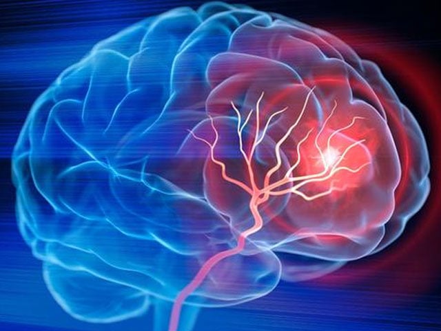 New test modality for stroke diagnosis